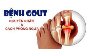 Nguyên nhân và cách phòng ngừa bệnh gout